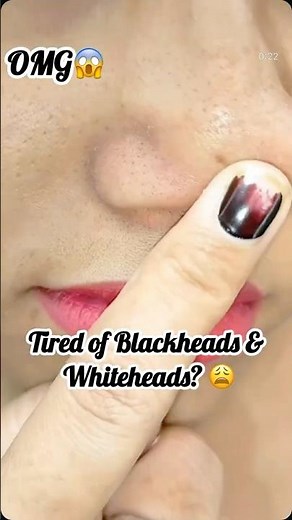 Instant Blackhead Removal! 😱✨ #skincare ‪@TheGlowReport_4‬
