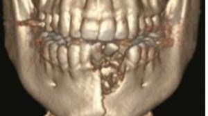 E-cigarette explodes in teen's mouth, breaks jaw and teeth