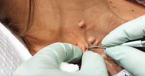 Dr. Pimple Popper Says This Is The Most Intense Surgery She's Performed All Year