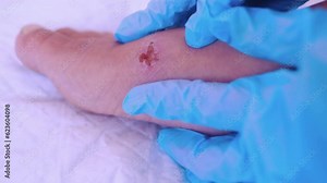 doctor treats weeping wound, trophic ulcer on female leg, wound exudate prevents healing ulcers by destroying growth factors, concept eliminating inflammatory process, sanitation pathogenic microflora