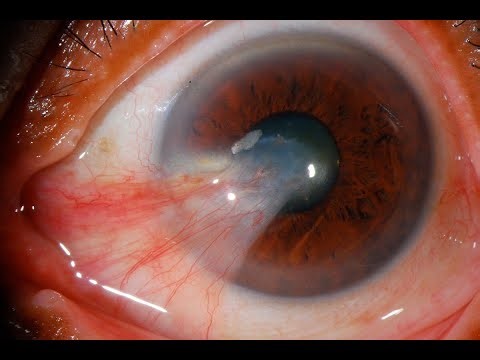 Pterygium the unwanted growth