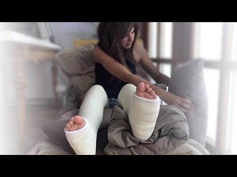 Zwei Gipsbeine (DLLC – Double Long Leg Cast)