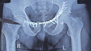 Doctor learn X-ray of a human pelvis bones with an implanted titanium plate and screws, indicating a fracture and other injury with surgical fixation. Scary trauma after auto accident. 4k footage.