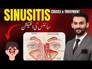 Sinusitis: The Ultimate Guide | Causes, Symptoms & Treatment