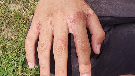 Key signs of brutal Victorian disease as cases surge throughout the UK