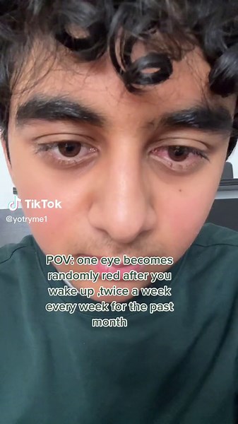 Understanding Red Eye and Conjunctivitis Symptoms