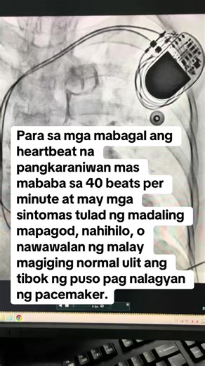 Paano Nakakatulong ang Pacemaker sa Bradycardia