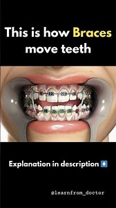 How Braces Fix Crooked Teeth | 3D Animation Explained #braces #orthodontics #dentaleducation