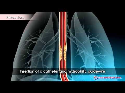Esophageal Stent