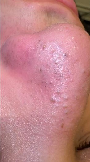 The largest amount of blackheads inside the nose #blackheads #skincare