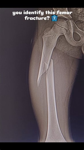 Ultra Scan Imaging Center on Instagram: "Can you identify this femur fracture? 🩻 This proximal femur X-ray shows an oblique fracture with clear bone displacement in the hip region. Femoral fractures like this often occur due to high-energy trauma, road traffic accidents, or falls. Proper radiology evaluation, digital X-ray imaging, and orthopedic diagnosis are essential for accurate fracture management. Comment your thoughts below! 💬 . . . . . #FemurFracture #ProximalFemur #SubtrochantericFrac