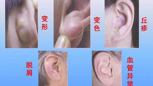 中医特色护理操作耳穴压豆PPT