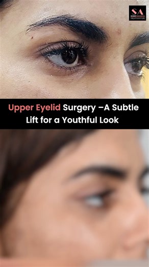 Upper Eyelid Surgery –A Subtle Lift for a Youthful Look #eyebrows #beauty | Blepharoplasty in Delhi