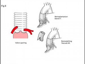 Tiron David procedure & Yacoub operation