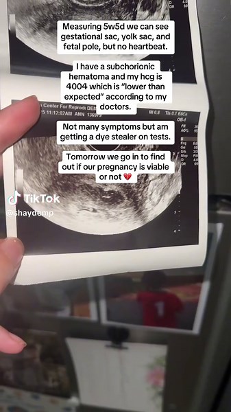 Understanding Subchorionic Hematoma in Early Pregnancy