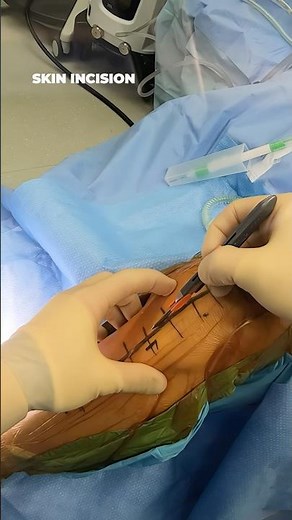 Is Robotic Knee Surgery Actually Better? What the Evidence Shows