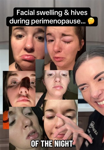 What do #perimenopause & facial swelling have in common? 🤔 You guessed it… HISTAMINE. 😅 If you’ve started experiencing… ☑️ New or worsening allergies ☑️ Asthmatic symptoms ☑️ Severe GI issues, reflux, nausea, diarrhea ☑️ Hives, eczema, dermatitis, swelling, itching ☑️ Rashes & flushing ☑️ Food & alcohol intolerances ☑️ Anxiety, heart palpitations, dizziness, & vertigo ☑️ Congestion, runny nose, post nasal drip ☑️ Brain fog (especially after eating) ☑️ Headaches/Migraines ☑️ Insomnia ☑️ Inflamm