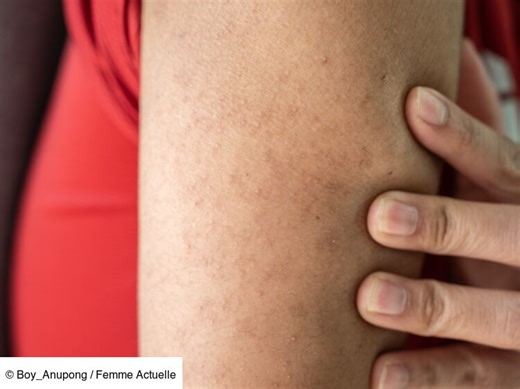"Peau de fraise” : 3 astuces de dermatologue pour venir à bout de la kératose pilaire