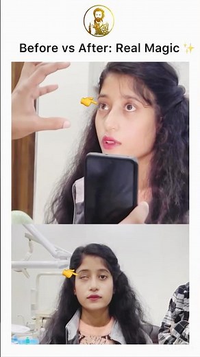 How to Fit Artificial Eye? 👁️