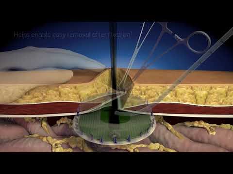 Phasix™ ST absorbable Mesh with Open Positioning System for hernia repair