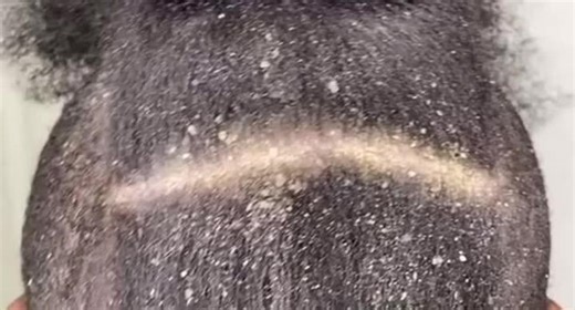 Soothing Dandruff Removal for Anxiety Relief | Quick Scratch Video