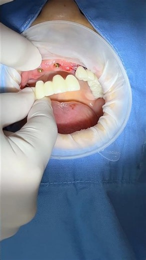 임플란트 MUA 임시치아 #dentist #전체임플란트 #dentist #dental #dentalprosthesis #dentistry