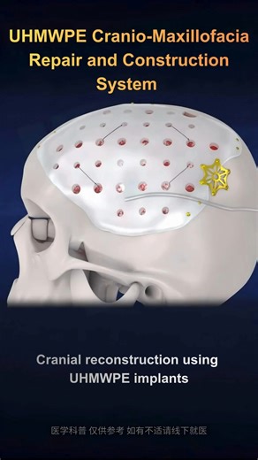Precision matters in cranial reconstruction. Discover how Double Medical 𝐔𝐇𝐌𝐖𝐏𝐄 𝐂𝐫𝐚𝐧𝐢𝐨-𝐌𝐚𝐱𝐢𝐥𝐥𝐨𝐟𝐚𝐜𝐢𝐚𝐥 𝐑𝐞𝐩𝐚𝐢𝐫 & 𝐑𝐞𝐜𝐨𝐧𝐬𝐭𝐫𝐮𝐜𝐭𝐢𝐨𝐧 𝐒𝐲𝐬𝐭𝐞𝐦 supports patient-specific cranial repair through advanced materials and 3D customization. 👇Watch the video to learn more. #CranialReconstruction #Neurosurgery #CMFSurgery #UHMWPE #MedicalImplants #3DCustomization #MedicalDeviceIndustry | Double Medical