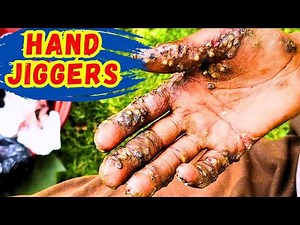 Hand Jiggers: The Parasite That Eats Your Skin From the Inside
