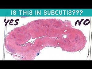 Quick trick to know if nodule is in subcutis (pathology dermpath dermatopathology dermatology)