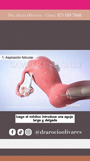 Proceso de Fertilización In Vitro: Paso a Paso