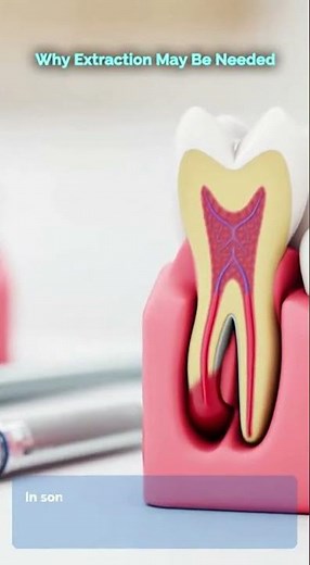 🦷 Abscess Tooth Extraction — What You Need to Know