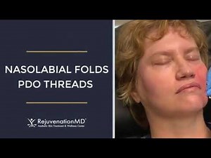 Smooth Nasolabial Folds with PDO Threads