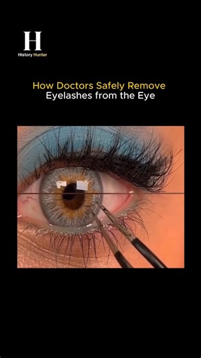 The History Hunter on Instagram: "Ever wondered how a tiny eyelash gets removed without hurting your eye? Doctors use precise and gentle techniques: Examine the eye under bright light or a slit lamp. Flush loose lashes with sterile saline. Carefully lift stuck lashes with a moistened cotton swab or sterile tweezers. For lashes under the eyelid, they may gently flip it for better access. Afterwards, soothing drops or antibiotics help prevent irritation and infection. 👀💧 ⚠️ Disclaimer: For educa