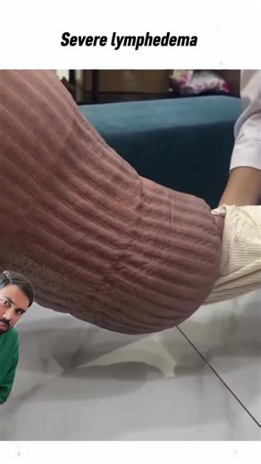 Understanding Lymphedema: Importance of Early Treatment