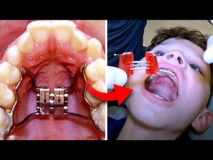 Getting Expander OFF… what happens when you get your Expander Off | McKinney Orthodontist