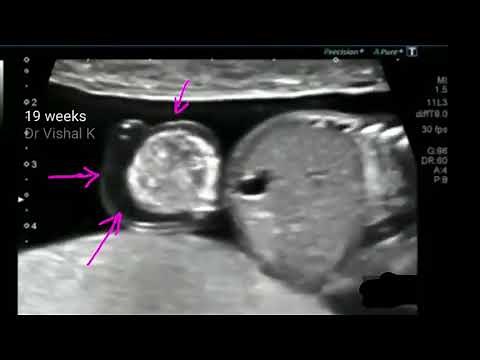 Omphalocele or exomphalos 3D ultrasound video