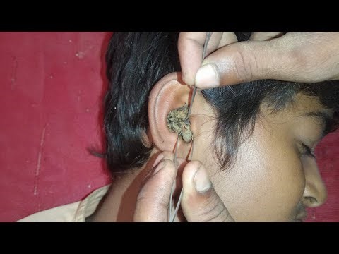 Deep Ear Cleaning Sounds for Ultimate Relaxation 👂✨