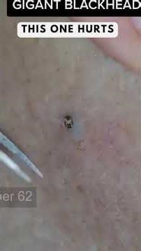 Removing large blackheads and pimples from face new 2026 #168