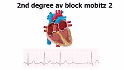 real ecg that demonstrate 2d degree av block Mobitz 2 along with...