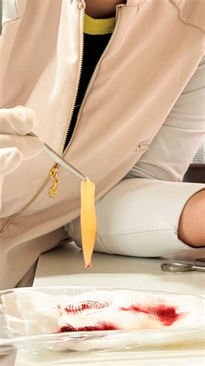 Instituto Kedima Marques | Cuiabá-MT on Instagram: "A associação do Endoform®, da matriz de fibrina e da terapia por pressão negativa potencializa o processo de cicatrização ao atuar diretamente na estrutura do leito da ferida. Enquanto o Endoform® oferece uma matriz biológica que favorece a regeneração tecidual, a matriz de fibrina estimula a resposta celular e a pressão negativa controla exsudato, reduz edema e acelera a formação de tecido viável. Tecnologia, ciência e critério clínico trabalh