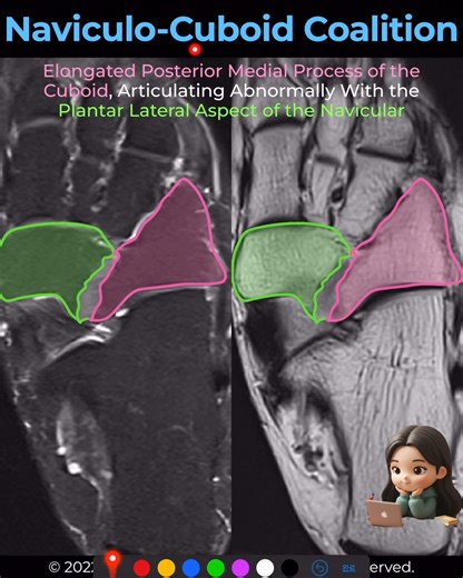MSKMRI | [Coalition 42] Naviculo-Cuboid (Cubonavicular) Coalition – The Rare One A naviculo-cuboid coalition is an uncommon congenital union between... | Instagram