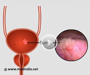 Bladder Tumor - Health Video | Medindia