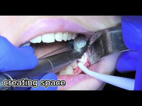 38 mesioangular impaction