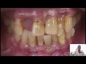 Immediate Implant Placements & Provisionals: A Step by Step narrative