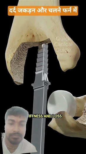 Elbow Replacement Surgery #shorts #health