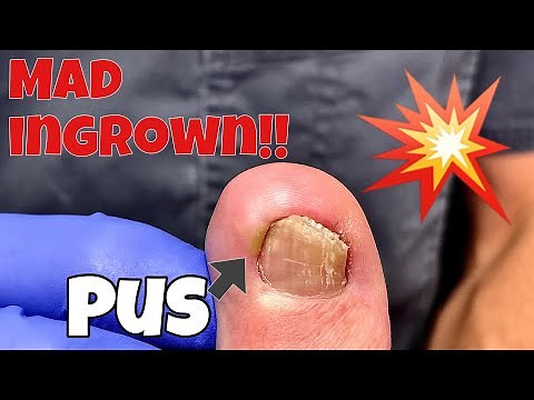 MAD INGROWN TOENAIL REMOVAL
