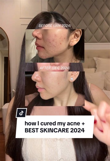 How I Cured My Acne: Best Skincare Tips for 2024