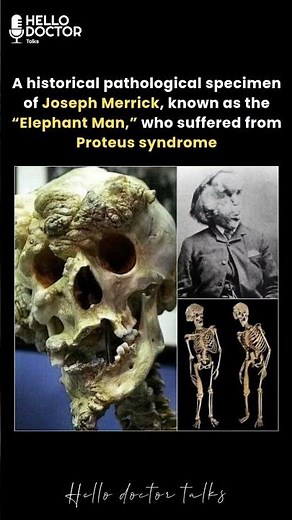 Joseph Merrick, known as the “Elephant Man,” who suffered from Proteus syndrome #healthchannel #doc