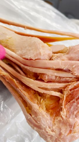 Understanding Tarsal Tunnel Syndrome