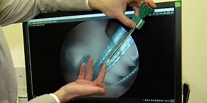 YOUR HEALTH: Cuff augmentation gets Randy back on the horse farm